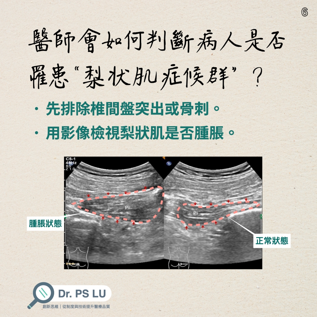 先排除椎間盤突出或骨刺。
用影像檢視梨狀肌是否腫脹。