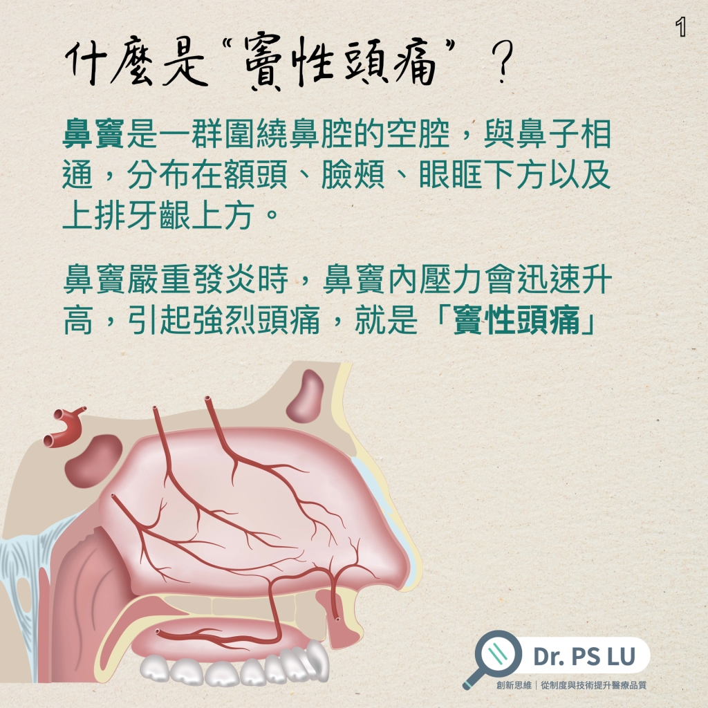 鼻竇是一群圍繞鼻腔的空腔，與鼻子相通，分布在額頭、臉頰、眼眶下方以及 上排牙齦上方。
鼻竇嚴重發炎時，鼻竇內壓力會迅速升高，引起強烈頭痛，就是「竇性頭痛」