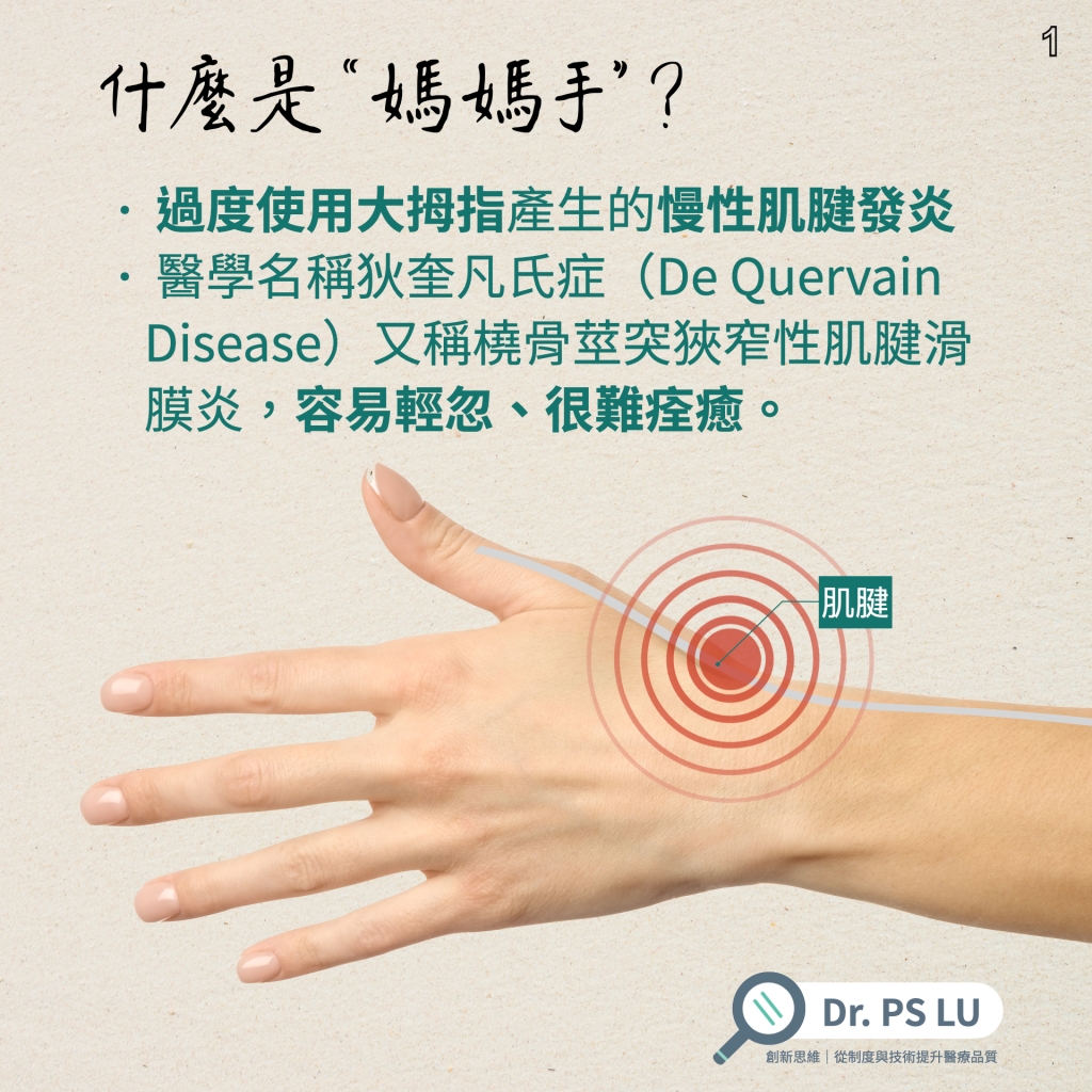 過度使用大拇指產生的慢性肌腱發炎
醫學名稱狄奎凡氏症（De Quervain Disease）又稱橈骨莖突狹窄性肌腱滑膜炎，容易輕忽、很難痊癒。