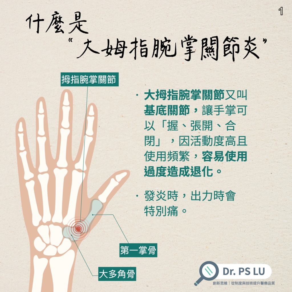 大拇指腕掌關節又叫基底關節，讓手掌可以「握、張開、合閉」，因活動度高且使用頻繁，容易使用過度造成退化。
發炎時，出力時會 特別痛。